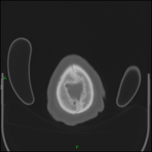 Cerebral contusions (Radiopaedia 33868-35039 Axial bone window 217).jpg