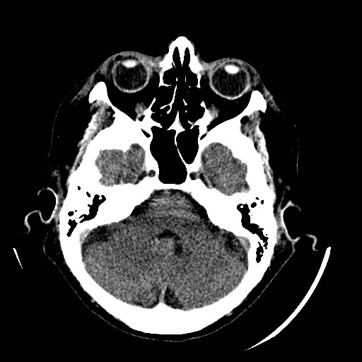 File:Cerebral edema (evolution in time) (Radiopaedia 19418-19440 non-contrast 29).jpg