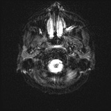 Cerebral embolic infarcts (embolic shower) (Radiopaedia 72391-82921 Axial DWI 1).jpg