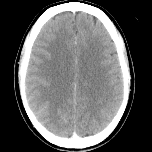 Cerebral hemorrhage secondary to arteriovenous malformation (Radiopaedia 33497-34561 B 35).png