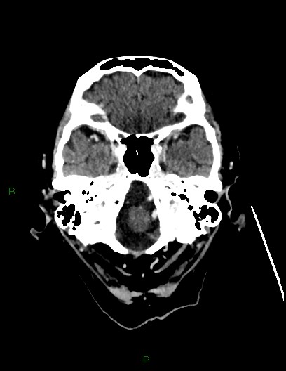 Cerebral metastases - ependymal and parenchymal (Radiopaedia 79877-93131 Axial C+ delayed 13).jpg