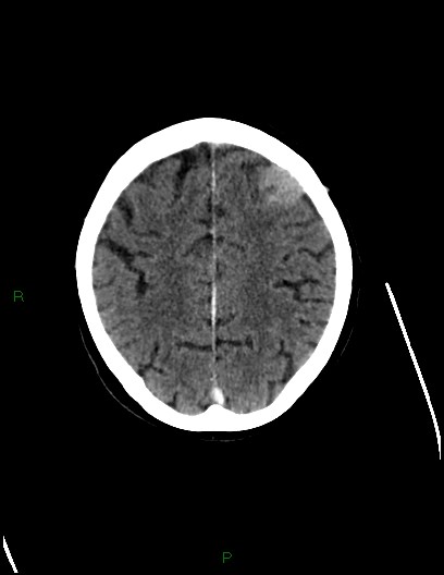 Cerebral metastases - ependymal and parenchymal (Radiopaedia 79877-93131 Axial C+ delayed 63).jpg