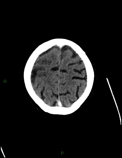 File:Cerebral metastases - ependymal and parenchymal (Radiopaedia 79877-93131 Axial C+ delayed 70).jpg