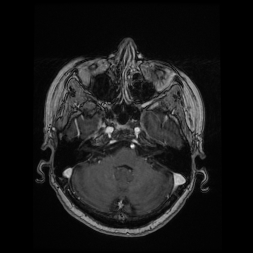 Cerebral metastases - melanoma (Radiopaedia 80972-94522 Axial T1 C+ 36).jpg