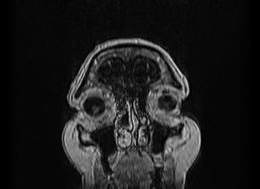 Cerebral metastases from lung cancer with amyloid angiopathy and cerebellopontine angle meningioma (Radiopaedia 74306-85191 Coronal T1 C+ 2).jpg