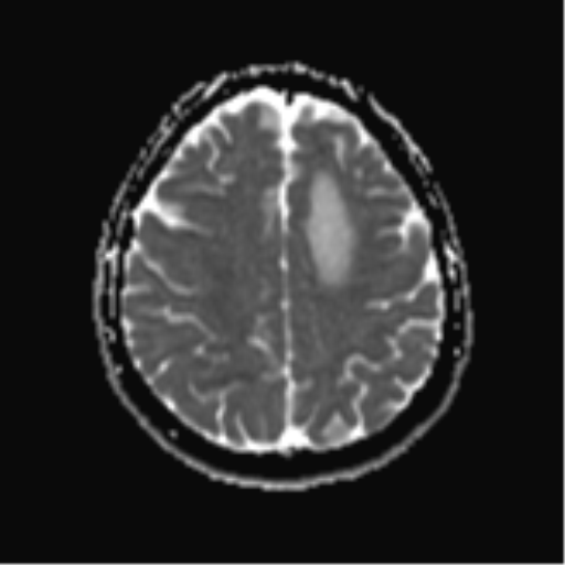 File:Cerebral metastases mimicking abscesses (Radiopaedia 45841-50131 Axial ADC 21).png