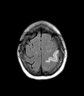 File:Cerebral metastasis (Radiopaedia 46744-51248 Axial FLAIR 24).png
