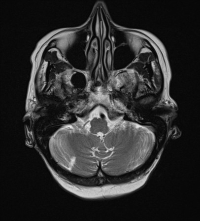 File:Cerebral metastasis (Radiopaedia 46744-51248 Axial T2 5).png