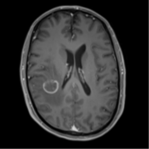Cerebral metastasis - melanoma (Radiopaedia 54718-60954 Axial T1 C+ fat sat 32).png