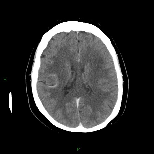 File:Cerebral metastasis from renal cell carcinoma (Radiopaedia 82306-96375 Axial C+ delayed 23).jpg