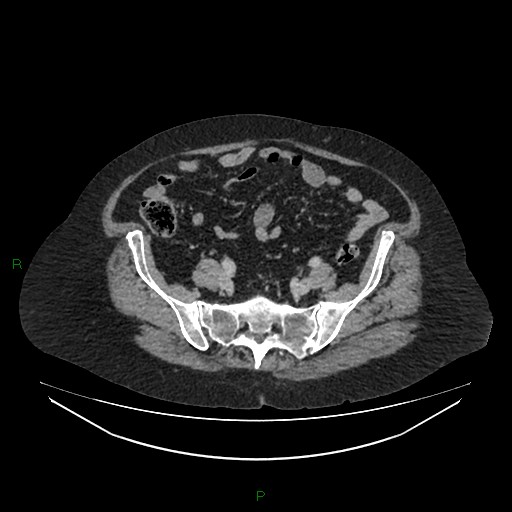 Cerebral metastasis from renal cell carcinoma (Radiopaedia 82306-96378 A 139).jpg