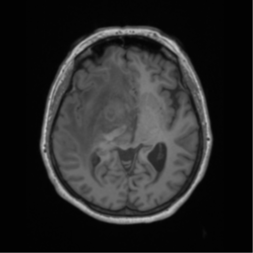 File:Cerebral metastasis to basal ganglia (Radiopaedia 81568-95413 Axial T1 33).png