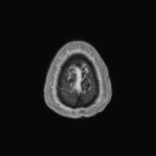 Cerebral metastasis to basal ganglia (Radiopaedia 81568-95413 Axial T1 C+ 72).png