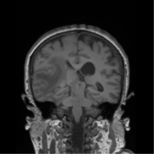 File:Cerebral metastasis to basal ganglia (Radiopaedia 81568-95413 Coronal T1 18).png