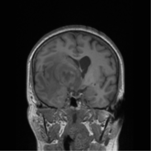 Cerebral metastasis to basal ganglia (Radiopaedia 81568-95413 Coronal T1 32).png