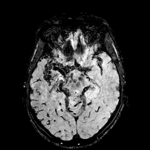 Cerebral parenchymal arteriovenous malformation (Radiopaedia 27280-27456 Axial SWI 43).jpg