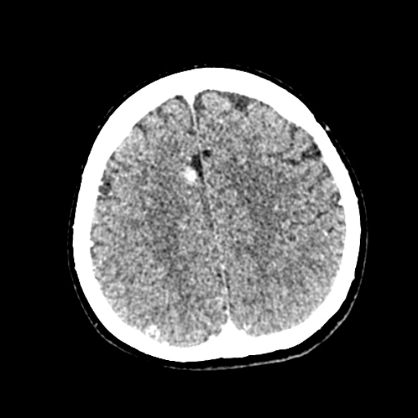 Cerebral ring enhancing lesions - cerebral metastases (Radiopaedia 44922-48818 B 208).jpg
