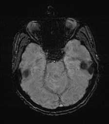 File:Cerebral toxoplasmosis (Radiopaedia 43956-47461 Axial SWI 13).jpg