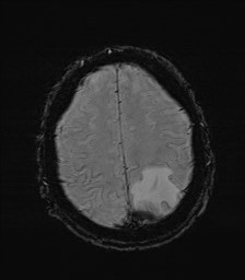 File:Cerebral toxoplasmosis (Radiopaedia 43956-47461 Axial SWI 32).jpg
