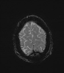File:Cerebral toxoplasmosis (Radiopaedia 43956-47461 Axial SWI 35).jpg