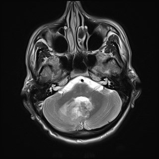 File:Cerebral toxoplasmosis (Radiopaedia 43956-47461 Axial T2 5).jpg