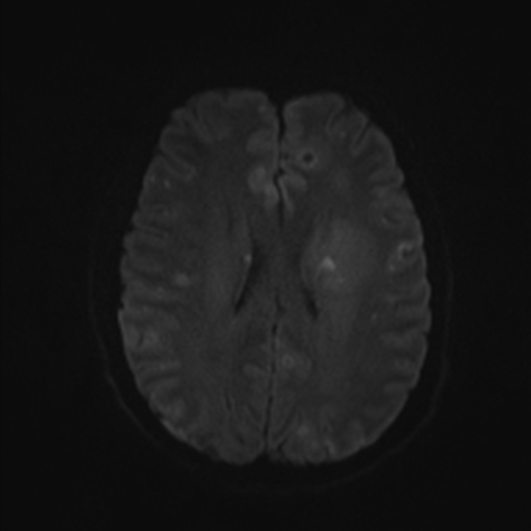 File:Cerebral toxoplasmosis (Radiopaedia 53993-60132 Axial DWI 44).jpg