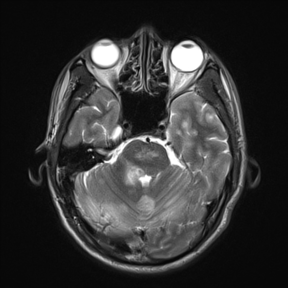 File:Cerebral toxoplasmosis (Radiopaedia 53993-60132 Axial T2 8).jpg