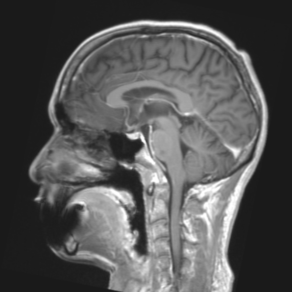 File:Cerebral toxoplasmosis (Radiopaedia 53993-61435 Coronal T1 17).jpg