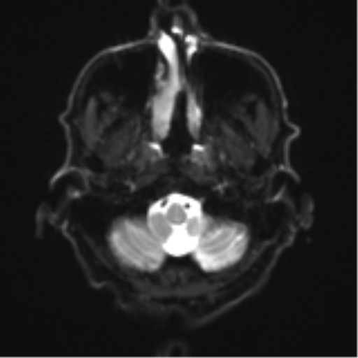 Cerebral toxoplasmosis (Radiopaedia 54575-60804 Axial DWI 6).png