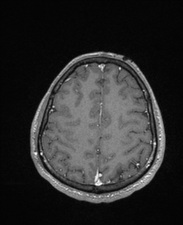Cerebral toxoplasmosis (Radiopaedia 85779-101597 Axial T1 C+ 126).jpg