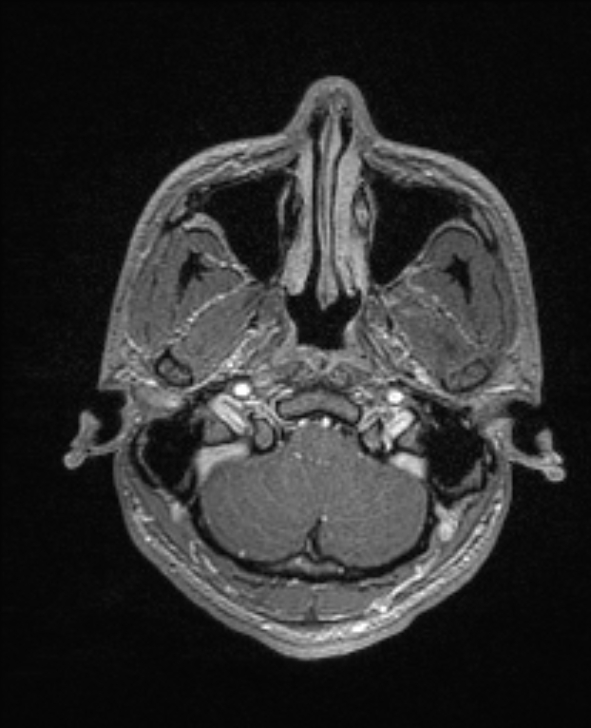 Cerebral toxoplasmosis (Radiopaedia 85779-101597 Axial T1 C+ 24).jpg