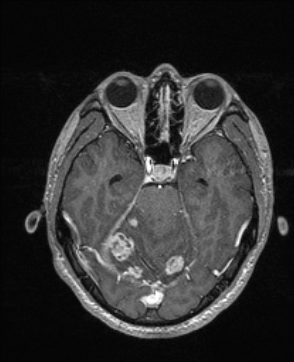Cerebral toxoplasmosis (Radiopaedia 85779-101597 Axial T1 C+ 57).jpg