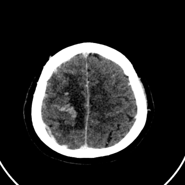 File:Cerebral venous hemorrhagic infarct from venous sinus thrombosis (Radiopaedia 55433-61883 Axial C+ delayed 31).jpg