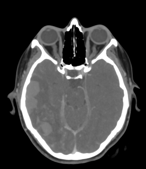 Cerebral venous hemorrhagic infarction (Radiopaedia 38461-40550 Axial MIP VENOGRAM 20).png