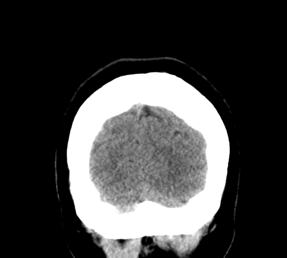File:Cerebral venous infarct related to dural venous sinus thromboses (Radiopaedia 35292-36804 Coronal non-contrast 33).png