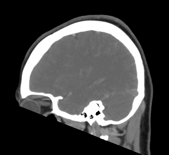 Cerebral venous infarction due to transverse sinus thrombosis (Radiopaedia 34688-36120 Sagittal CT venogram 18).png
