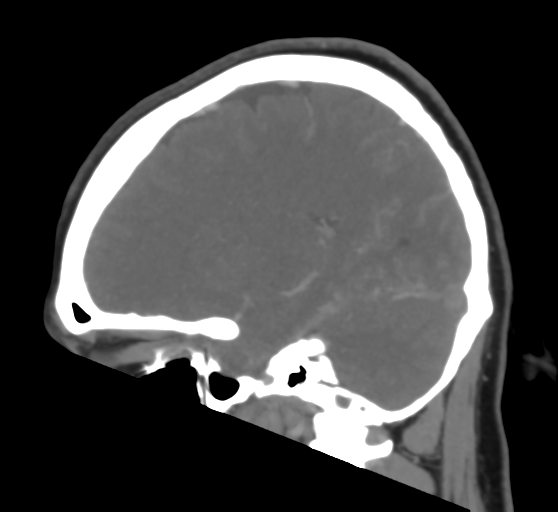 File:Cerebral venous infarction due to transverse sinus thrombosis (Radiopaedia 34688-36120 Sagittal CT venogram 22).png