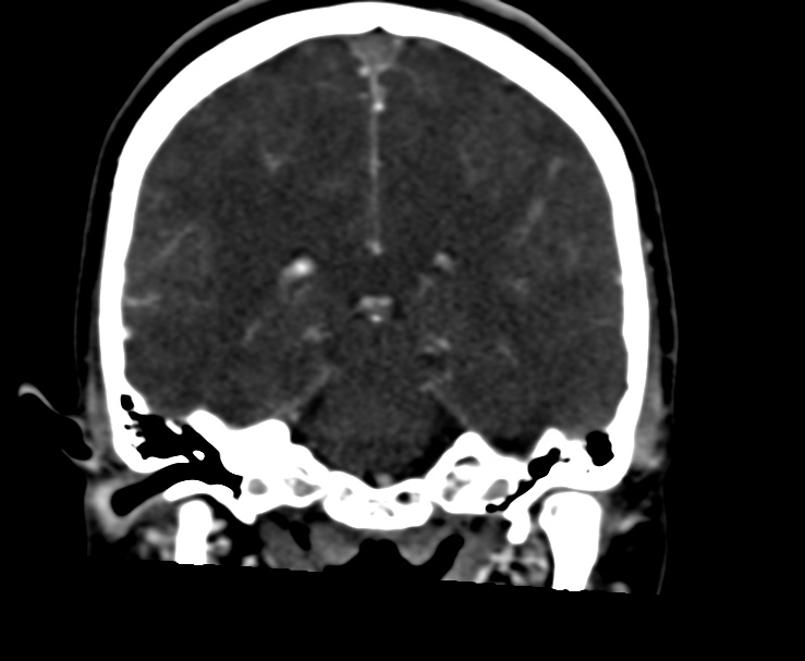 Cerebral venous sinus thrombosis (Radiopaedia 59224-66646 Coronal C+ delayed 45).jpg