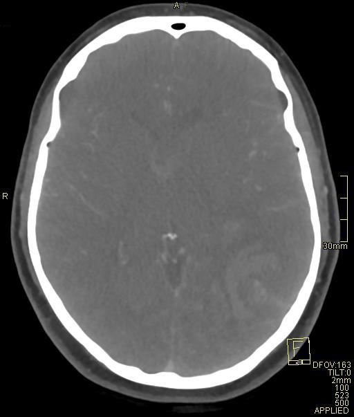Cerebral venous sinus thrombosis (Radiopaedia 91329-108965 Axial venogram 42).jpg
