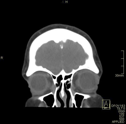 File:Cerebral venous sinus thrombosis (Radiopaedia 91329-108965 Coronal venogram 12).jpg
