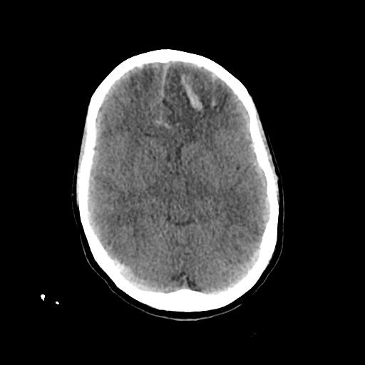 Cerebral venous throbmosis - hemorrhagic venous infarction (Radiopaedia 87318-103613 Axial non-contrast 71).jpg