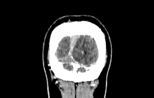 Cerebral venous thrombosis (CVT) (Radiopaedia 77524-89685 C 63).jpg