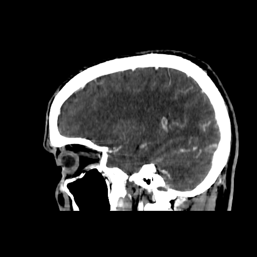 File:Cerebral venous thrombosis (CVT) (Radiopaedia 77524-89685 Sagittal CTV 12).jpg