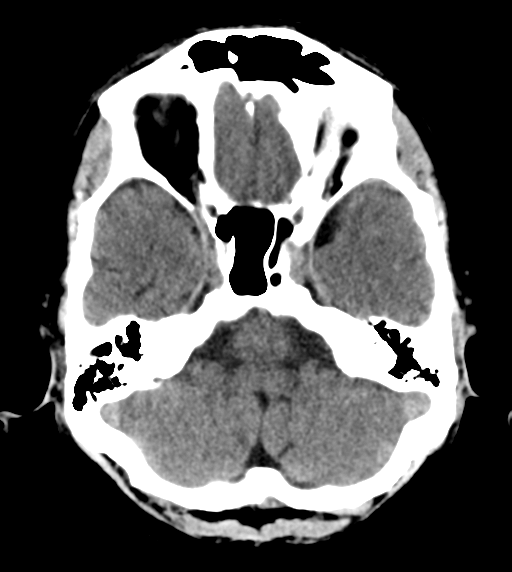 File:Cerebral venous thrombosis (Radiopaedia 38392-40467 Axial non-contrast 7).png