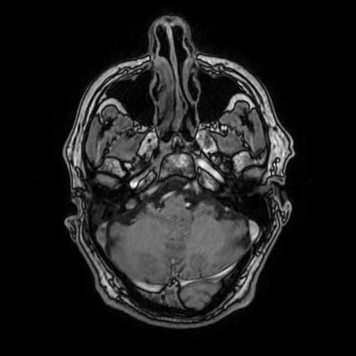File:Cerebral venous thrombosis with secondary intracranial hypertension (Radiopaedia 89842-106957 Axial T1 C+ 52).jpg