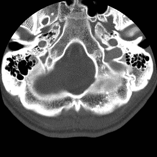Cervical Pott disease (Radiopaedia 20374-20286 Axial bone window 3).jpg
