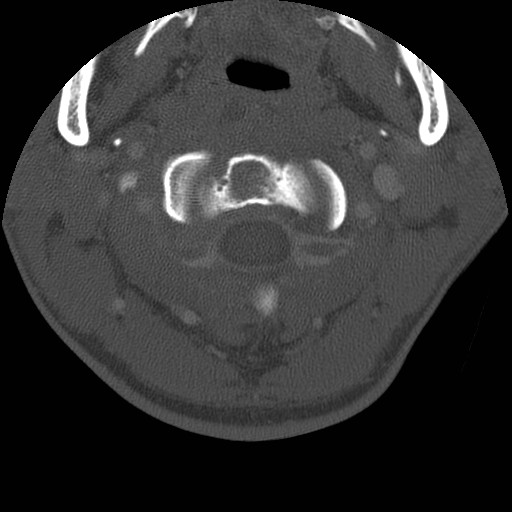 Cervical Pott disease (Radiopaedia 20374-20286 Axial bone window 30).jpg