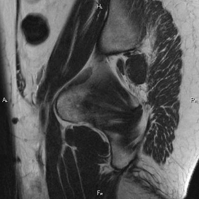 File:Cervical adenocarcinoma (Radiopaedia 65011-73985 Sagittal T2 1).jpg