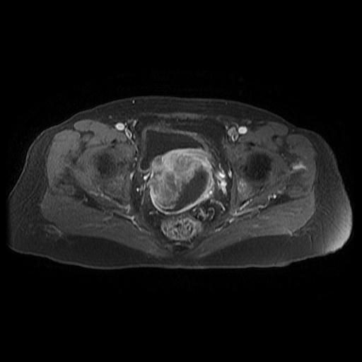 File:Cervical carcinoma (Radiopaedia 67644-77047 Axial T1 C+ fat sat 14).jpg