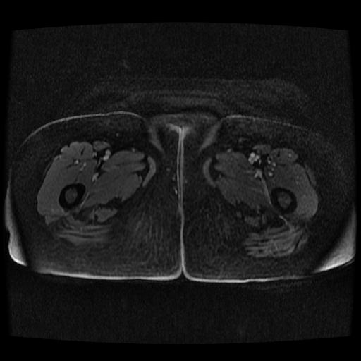 Cervical carcinoma (Radiopaedia 70924-81132 Axial T1 C+ fat sat 183).jpg